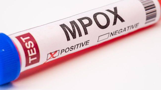 Kasus MPOX pertama di Luar Afrika
