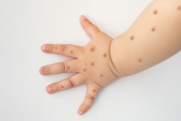 Waspada Mpox pada Anak: Gejala dan Tindakan yang Perlu Diambil