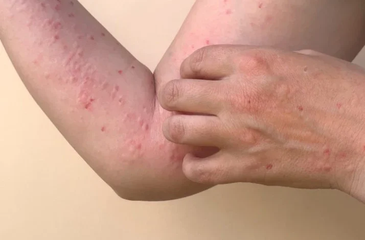 8 Kasus Mpox di Indonesia, Menkes: Tidak Perlu Khawatir, Bisa Diobati